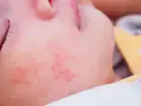 Dị ứng và phòng ngừa dị ứng bằng dinh dưỡng (videos)