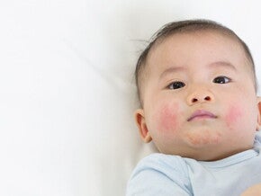 Chẩn đoán và điều trị dị ứng đạm sữa bò (publications)