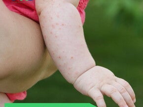 Cập nhật về phòng ngừa dị ứng (publications)