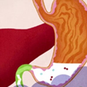 Trào ngược Dạ dày - Thực quản (videos)