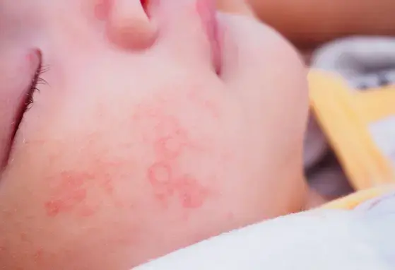 Dị ứng và phòng ngừa dị ứng bằng dinh dưỡng (videos) Dị ứng và phòng ngừa dị ứng bằng dinh dưỡng (videos)
