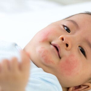 Điểm số triệu chứng liên quan đến sữa bò (CoMiSS) (publications)